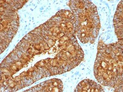 Immunohistochemistry-Paraffin: MAML3 Antibody (MAML3/1303) [NBP2-47646] - Formalin-fixed, paraffin-embedded Human Colon Carcinoma stained with MAML3 Monoclonal Antibody (MAML3/1303).