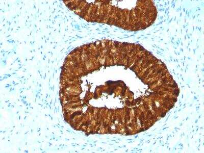 Immunohistochemistry-Paraffin: MAML3 Antibody (MAML3/1303) [NBP2-47646] - Formalin-fixed, paraffin-embedded Human Cervical Carcinoma stained with MAML3 Monoclonal Antibody (MAML3/1303).