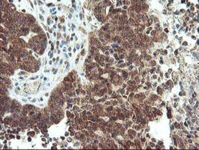 Immunohistochemistry-Paraffin: MAO-A Antibody (2F10) [NBP2-01752] - Staining of paraffin-embedded Adenocarcinoma of Human ovary tissue using anti-Monoamine Oxidase A mouse monoclonal antibody.