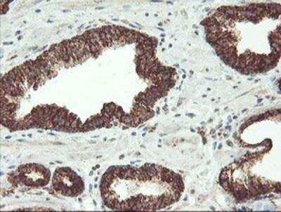 Immunohistochemistry-Paraffin: MAO-A Antibody (2F10) [NBP2-01752] - Staining of paraffin-embedded Carcinoma of Human prostate tissue using anti-Monoamine Oxidase A mouse monoclonal antibody.