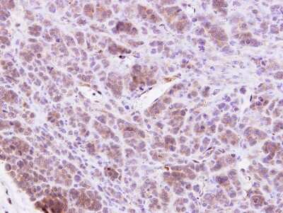 Immunohistochemistry-Paraffin: MAP4K1 Antibody [NBP1-31000] - BT438 xenograft.  MAP4K1 antibody [N1], N-term  dilution: 1:500. Antigen Retrieval: Trilogy™ (EDTA based, pH 8.0) buffer, 15min. 