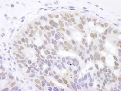 Immunohistochemistry: MAPKAP Kinase 3 Antibody [NBP2-32092] - Sample: FFPE section of human ovarian carcinoma. Antibody: Affinity purified rabbit anti- 3pK used at a dilution of 1:1,000 (1ug/ml). Detection: DAB. Counterstain: IHC Hematoxylin (blue).