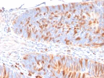 Immunohistochemistry-Paraffin: MBD1 Antibody (CPTC-MBD1-1) - Azide and BSA Free [NBP3-08387] - Formalin-fixed, paraffin-embedded human colon stained with MBD1 Mouse Monoclonal Antibody (CPTC-MBD1-1)