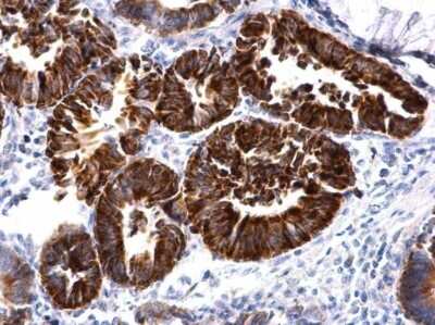 Immunohistochemistry-Paraffin: MBNL2 Antibody [NBP2-43638] - Analysis of human colon carcinoma. MBNL2 antibody dilution: 1:500.