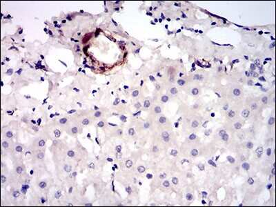 Immunohistochemistry: MCAM/CD146 Antibody (6C3F1) [NBP2-37318] - Immunohistochemical analysis of paraffin-embedded liver cancer tissues using MCAM mouse mAb with DAB staining.
