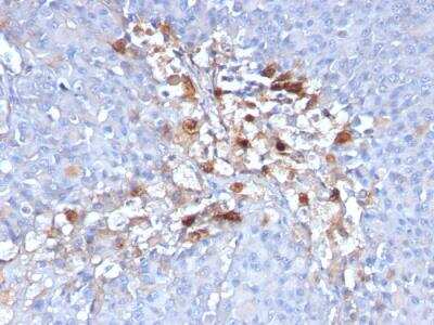 Immunohistochemistry-Paraffin: MCAM/CD146 Antibody (C146/634) - IHC-Prediluted [NBP2-48199] - Formalin-fixed, paraffin-embedded human Melanoma stained with CD146 Monoclonal Antibody (C146/634)