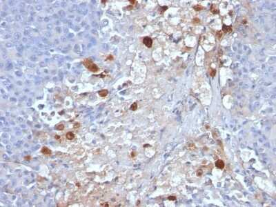 Immunohistochemistry-Paraffin: MCAM/CD146 Antibody (MCAM/1101) [NBP2-44509] - Human Melanoma stained with MCAM Monoclonal Antibody (MCAM/1101)