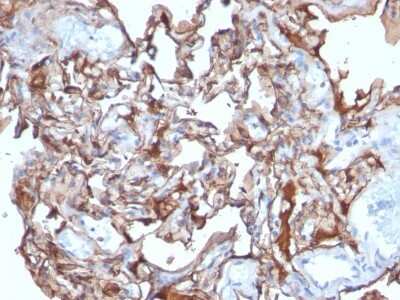 Immunohistochemistry-Paraffin: MCAM/CD146 Antibody (MCAM/1101) [NBP2-44509] - Human Melanoma stained with MCAM Monoclonal Antibody (MCAM/1101)