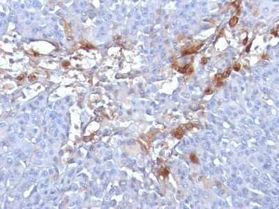 Immunohistochemistry-Paraffin: MCAM/CD146 Antibody (MUC18/1130) - Azide and BSA Free [NBP2-47777] - Human Melanoma stained with MUC18 Monoclonal Antibody (MUC18/1130)