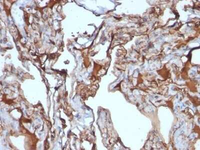 Immunohistochemistry-Paraffin: MCAM/CD146 Antibody (MUC18/1130) - Azide and BSA Free [NBP2-47777] - Human Melanoma stained with MUC18 Monoclonal Antibody (MUC18/1130)