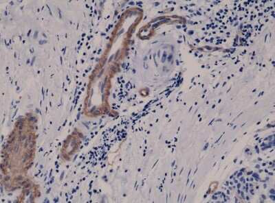 Immunohistochemistry-Paraffin: MCAM/CD146 Antibody (RM249) [NBP2-61563] - Immunohistochemical staining of formalin fixed and paraffin embedded Human breast cancer tissue sections using NBP2-61563.