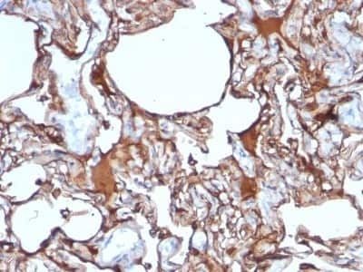 Immunohistochemistry-Paraffin: MCAM/CD146 Antibody (SPM620) [NBP2-44510] - Human Melanoma stained with MCAM Monoclonal Antibody (SPM620)