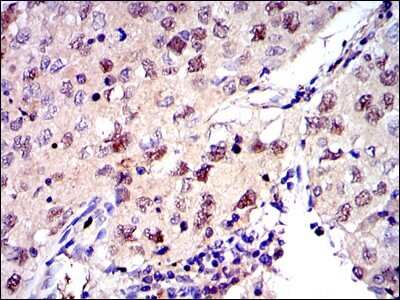 Immunohistochemistry: MCM2 Antibody (2B3) [NBP2-37566] - Immunohistochemical analysis of paraffin-embedded lung cancer tissues using MCM2 mouse mAb with DAB staining.