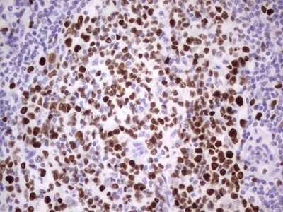 Immunohistochemistry: MCM2 Antibody (3C12) [NBP2-45774] - Analysis of Carcinoma of Human lung tissue.(Heat-induced epitope retrieval by 1 mM EDTA in 10mM Tris, pH8.5, 120C for 3min)