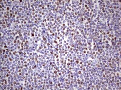 Immunohistochemistry: MCM2 Antibody (3C12) [NBP2-45774] - Analysis of Human lymphoma tissue. (Heat-induced epitope retrieval by 1 mM EDTA in 10mM Tris, pH8.5, 120C for 3min)