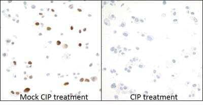 Immunocytochemistry: MCM2 Antibody (BLR108H) [NBP3-07021] - Detection of human Phospho-MCM2 (S53) in FFPE OVCAR-4 cells by ICC. Antibody: Rabbit anti-MCM2 (S53) recombinant monoclonal [BLR108H]. Secondary: HRP-conjugated goat anti-rabbit IgG  Substrate: DAB.