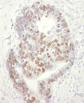 <b>Biological Strategies Validation. </b>Immunohistochemistry: MCM3 Antibody [NB100-249] - Sample: FFPE section of human colon carcinoma. Antibody: Affinity purified goat anti-MCM3 used at a dilution of 1:1,000 (1ug/ml). Detection: DAB