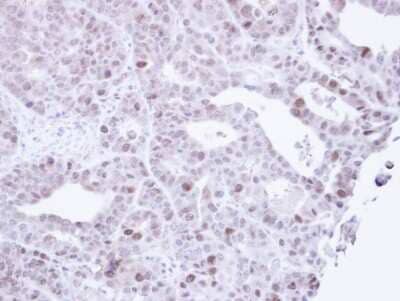 Immunohistochemistry-Paraffin: MCM3 Antibody [NBP1-33028] - Paraffin-embedded NCIN87 Xenograft, using antibody at 1:100 dilution.