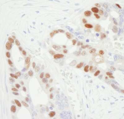 <b>Biological Strategies Validation. </b>Immunohistochemistry: MCM6 Antibody [NB100-251] - Sample: FFPE section of human ovarian carcinoma. Antibody: Affinity purified goat anti-MCM6 used at a dilution of 1:1,000 (1ug/ml). Detection: DAB