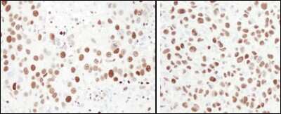 Immunohistochemistry-Paraffin: MCM6 Antibody [NB100-291] - Human breast carcinoma (left) and mouse squamous cell carcinoma (right). Antibody: Affinity purified rabbit anti-MCM6 used at a dilution of 1:1,000 (1ug/ml). Detection: DAB