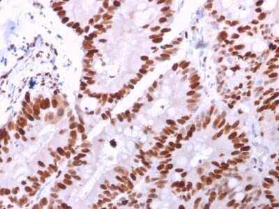 Immunohistochemistry-Paraffin: MCM6 Antibody (MCM6/2999) - Azide and BSA Free [NBP2-79862] - Formalin-fixed, paraffin-embedded human Colon Carcinoma stained with MCM6 Antibody (MCM6/2999).