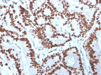 Immunohistochemistry-Paraffin: MCM6 Antibody (MCM6/3000) [NBP2-79728] - Formalin-fixed, paraffin-embedded human Colon Carcinoma stained with MCM6 Antibody (MCM6/3000).
