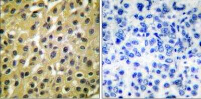 Immunohistochemistry: MDM2/HDM2 Antibody [NBP1-67627] - Analysis of paraffin-embedded human breast carcinoma tissue, using MDM2 Antibody. The picture on the right isblocked with the synthesized peptide. 