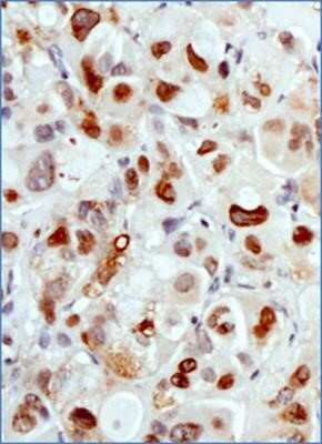 Immunohistochemistry: MDM2/HDM2 Antibody (SMP14) - Azide and BSA Free [NBP2-80845] - Analysis of tissue section of human breast cancer xenograft using MDM2/HDM2 antibody (clone SMP14) at 1:100 dilution. Several of the cancer cells developed a strong nuclear with weak cytoplasmic immunostaining of MDM2. Image from the standard format of th