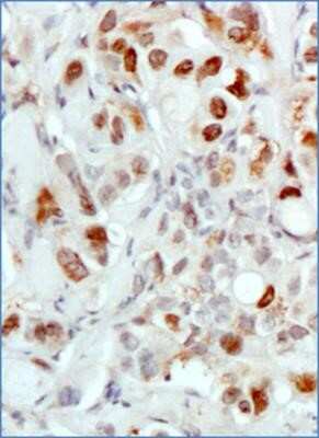 Immunohistochemistry: MDM2/HDM2 Antibody (SMP14) - Azide and BSA Free [NBP2-80845] - Analysis of tissue section of human breast cancer xenograft using MDM2/HDM2 antibody (clone SMP14) at 1:100 dilution. Several of the cancer cells developed a strong nuclear with weak cytoplasmic immunostaining of MDM2. Image from the standard format of th