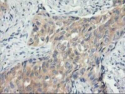 Immunohistochemistry: MDS028 Antibody (OTI3C4) - Azide and BSA Free [NBP2-72614] - Staining of paraffin-embedded Carcinoma of Human lung tissue using anti-MDS028 mouse monoclonal antibody.