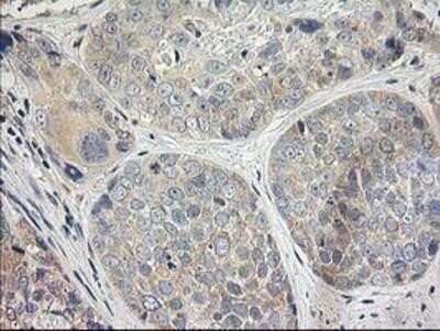 Immunohistochemistry-Paraffin: MDS028 Antibody (OTI3C4) [NBP2-00860] - Staining of paraffin-embedded Adenocarcinoma of Human breast tissue using anti-MDS028 mouse monoclonal antibody.