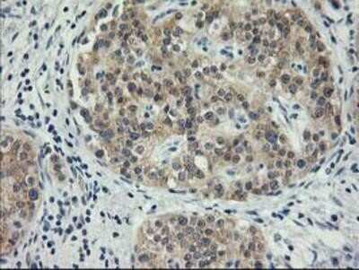 Immunohistochemistry-Paraffin: MDS028 Antibody (OTI3C4) [NBP2-00860] - Staining of paraffin-embedded Carcinoma of Human pancreas tissue using anti-MDS028 mouse monoclonal antibody.