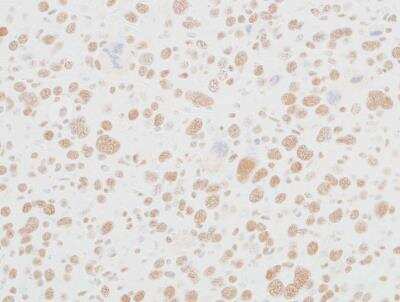Immunohistochemistry: MED12 Antibody (BLR084G) [NBP2-80138] - Detection of mouse MED12 in FFPE renal carcinoma by IHC. Antibody: Rabbit anti-MED12 recombinant monoclonal [BLR084G] (NBP2-80138). Secondary: HRP-conjugated goat anti-rabbit IgG. Substrate: DAB.