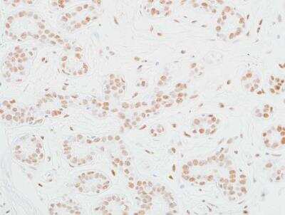 Immunohistochemistry: MED12 Antibody (BLR084G) [NBP2-80138] - Detection of human MED12 in FFPE breast carcinoma by IHC. Antibody: Rabbit anti-MED12 recombinant monoclonal [BLR084G] (NBP2-80138). Secondary: HRP-conjugated goat anti-rabbit IgG. Substrate: DAB.