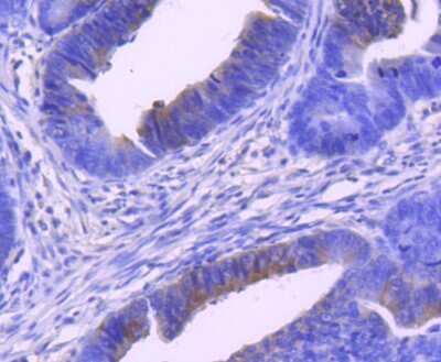 Immunohistochemistry-Paraffin: MEK1 [p Ser298] Antibody (SD206-7) [NBP2-67770] - Analysis of paraffin-embedded human colon cancer tissue using anti-Phospho-MEK1 (S298) antibody. Counter stained with hematoxylin.