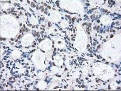 Immunohistochemistry: MEK2 Antibody (OTI8G6) - Azide and BSA Free [NBP2-72646] - Staining of paraffin-embedded Adenocarcinoma of Human colon tissue using anti-MEK2 mouse monoclonal antibody.
