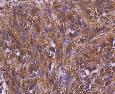 Immunohistochemistry-Paraffin: MEK2 Antibody (SD207-08) [NBP2-67791] - Analysis of paraffin-embedded human breast carcinoma tissue using anti-MEK2 antibody. Counter stained with hematoxylin.