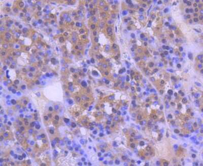 Immunohistochemistry-Paraffin: MEK2 Antibody (SD207-08) [NBP2-67791] - Analysis of paraffin-embedded human liver cancer tissue using anti-MEK2 antibody. Counter stained with hematoxylin.