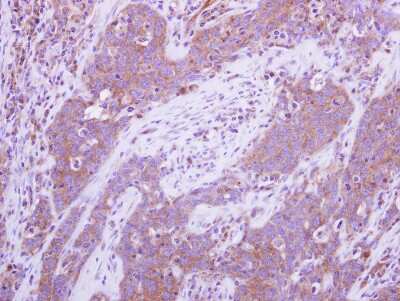 Immunohistochemistry-Paraffin: MEK7 Antibody [NBP2-17272] - Immunohistochemical analysis of paraffin-embedded adenocarcinoma, using antibody at 1:250 dilution.