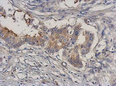 Immunohistochemistry-Paraffin: MEKK3 Antibody [NBP2-17273] - Immunohistochemical analysis of paraffin-embedded Gastric ca, using antibody at 1:500 dilution.