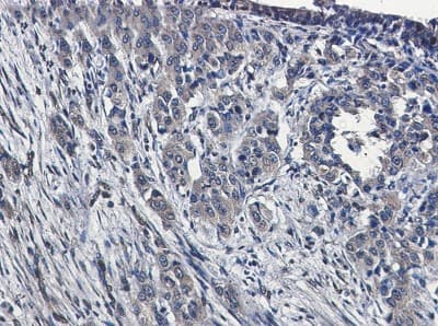 Immunohistochemistry-Paraffin: MEKK4 Antibody (S05-8A5) [NBP3-19990] - Immunohistochemistry of MEKK4 in paraffin-embedded Human lung cancer tissue using NBP3-19990 at dilution 1/50