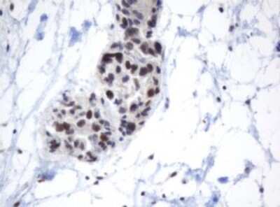 Immunohistochemistry: METT10D Antibody (3E8) [NBP2-45823] - Analysis of Adenocarcinoma of Human ovary tissue. (Heat-induced epitope retrieval by 10mM citric buffer, pH6.0, 120C for 3min)