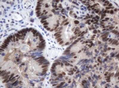 Immunohistochemistry: METT10D Antibody (3E8) [NBP2-45823] - Analysis of Adenocarcinoma of Human colon tissue. (Heat-induced epitope retrieval by 10mM citric buffer, pH6.0, 120C for 3min)