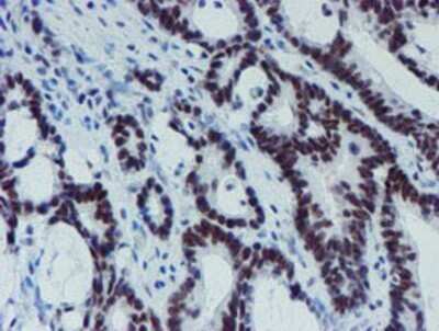 Immunohistochemistry: METT10D Antibody (OTI3B5) - Azide and BSA Free [NBP2-72654] - Staining of paraffin-embedded Adenocarcinoma of Human colon tissue using anti-METT10D mouse monoclonal antibody.