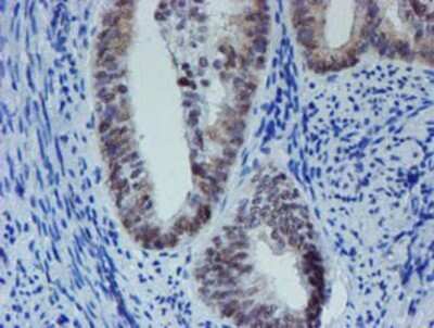 Immunohistochemistry: METT10D Antibody (OTI3B5) - Azide and BSA Free [NBP2-72654] - Staining of paraffin-embedded Adenocarcinoma of Human endometrium tissue using anti-METT10D mouse monoclonal antibody.