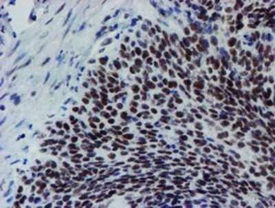 Immunohistochemistry: METT10D Antibody (OTI3B5) - Azide and BSA Free [NBP2-72654] - Staining of paraffin-embedded Carcinoma of Human bladder tissue using anti-METT10D mouse monoclonal antibody.