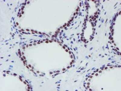 Immunohistochemistry: METT10D Antibody (OTI3B5) - Azide and BSA Free [NBP2-72654] - Staining of paraffin-embedded Carcinoma of Human prostate tissue using anti-METT10D mouse monoclonal antibody.
