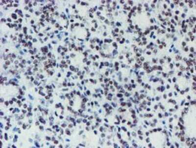 Immunohistochemistry: METT10D Antibody (OTI3B5) - Azide and BSA Free [NBP2-72654] - Staining of paraffin-embedded Carcinoma of Human thyroid tissue using anti-METT10D mouse monoclonal antibody.