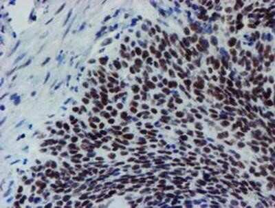 Immunohistochemistry-Paraffin: METT10D Antibody (OTI3B5) [NBP2-02026] - Staining of paraffin-embedded Carcinoma of Human bladder tissue using anti-METT10D mouse monoclonal antibody.