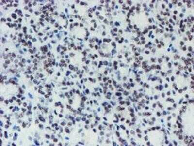Immunohistochemistry-Paraffin: METT10D Antibody (OTI3B5) [NBP2-02026] - Staining of paraffin-embedded Carcinoma of Human thyroid tissue using anti-METT10D mouse monoclonal antibody.